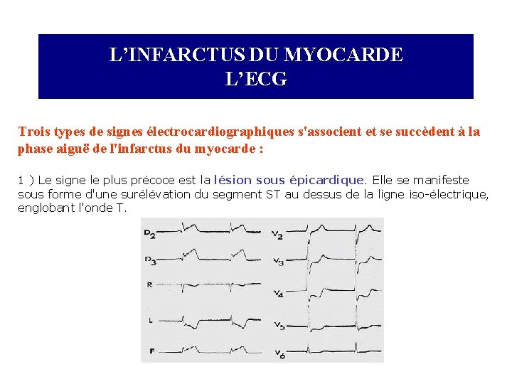 L’INFARCTUS DU MYOCARDE L’ECG Trois types de signes électrocardiographiques s'associent et se succèdent à