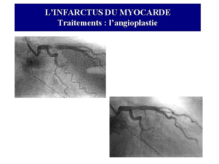 L’INFARCTUS DU MYOCARDE Traitements : l’angioplastie 