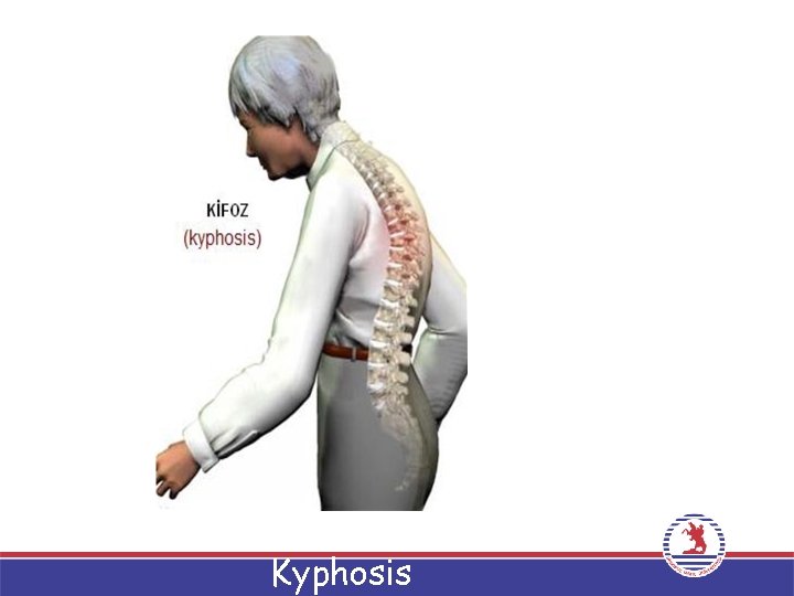 Kyphosis 