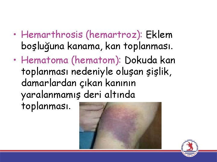  • Hemarthrosis (hemartroz): Eklem boşluğuna kanama, kan toplanması. • Hematoma (hematom): Dokuda kan