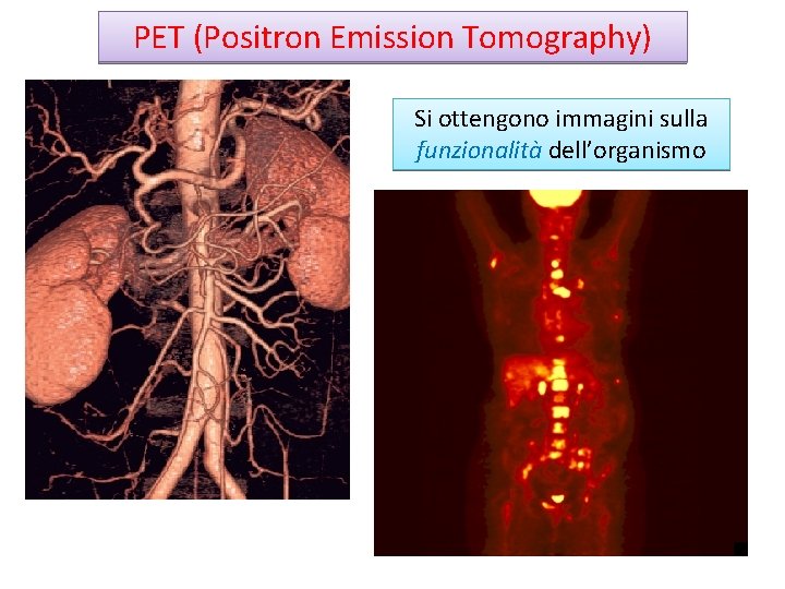 PET (Positron Emission Tomography) Si ottengono immagini sulla funzionalità dell’organismo 