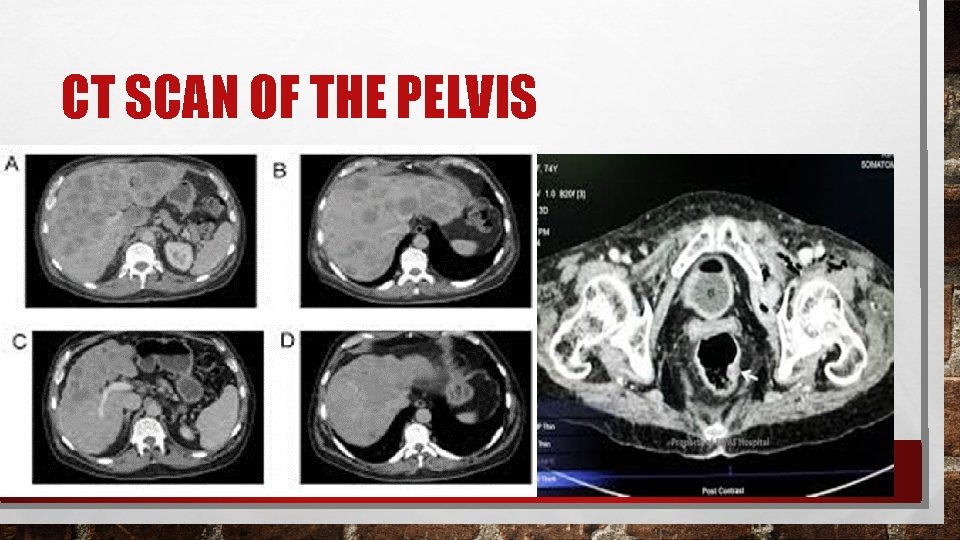 CT SCAN OF THE PELVIS 