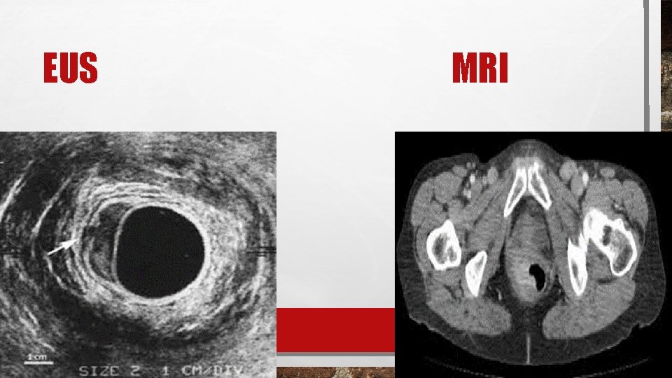 EUS MRI 