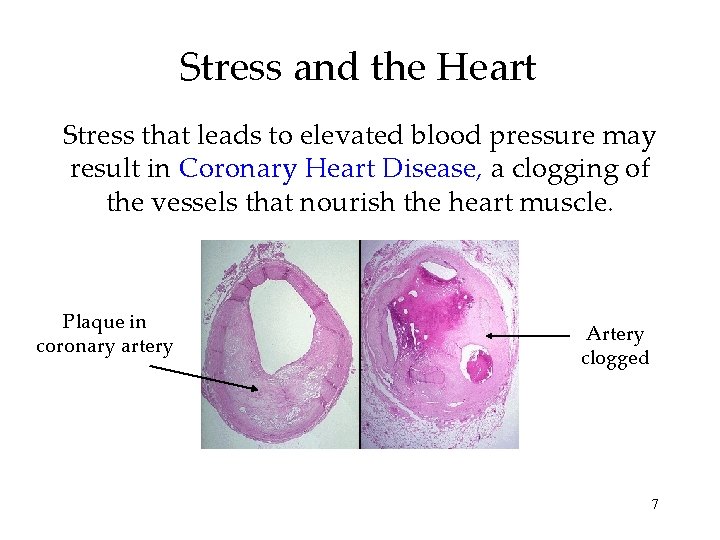 Stress and the Heart Stress that leads to elevated blood pressure may result in