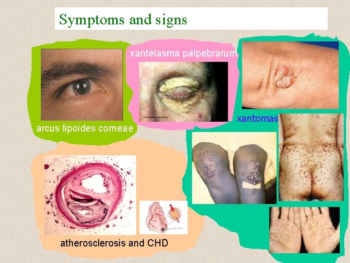 Symptoms and signs xantelasma palpebrarum arcus lipoides corneae atherosclerosis and CHD xantomas 