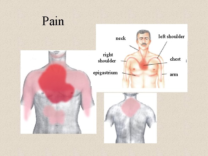 Pain neck right shoulder epigastrium left shoulder chest arm 