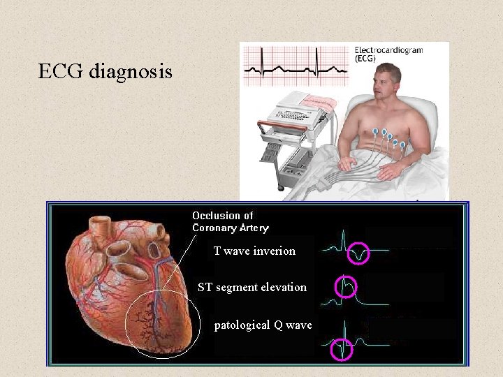 ECG diagnosis T wave inverion ST segment elevation patological Q wave 