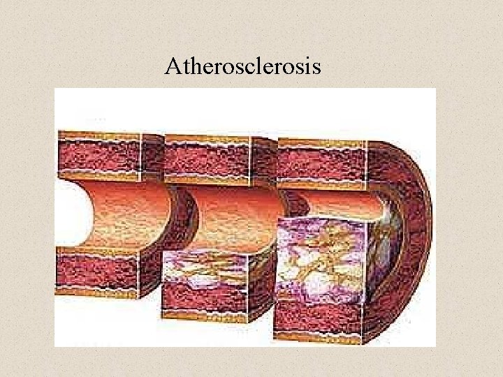 Atherosclerosis 