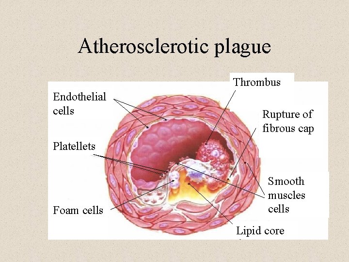 Atherosclerotic plague Thrombus Endothelial cells Rupture of fibrous cap Platellets Foam cells Smooth muscles