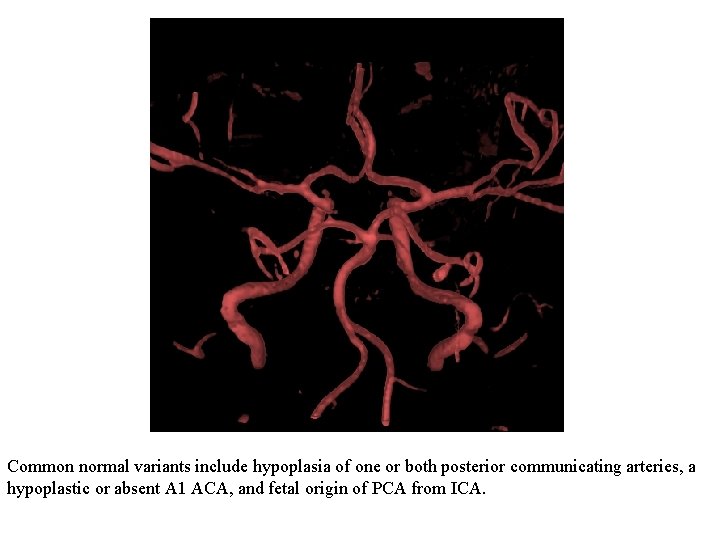 Common normal variants include hypoplasia of one or both posterior communicating arteries, a hypoplastic