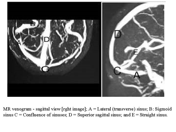 MR venogram - sagittal view [rght image]; A = Lateral (transverse) sinus; B: Sigmoid