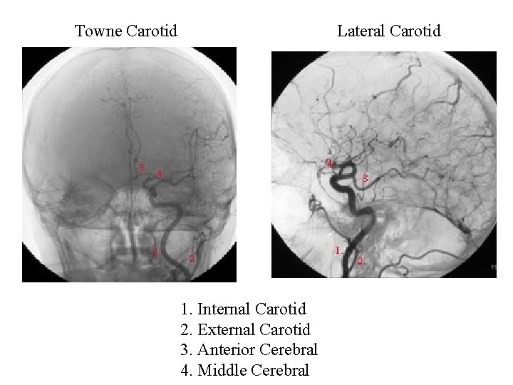 Towne Carotid Lateral Carotid 1. Internal Carotid 2. External Carotid 3. Anterior Cerebral 4.