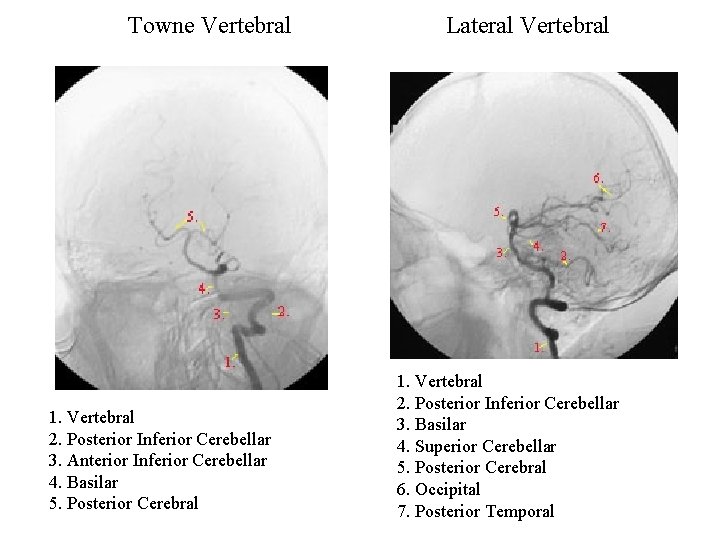 Towne Vertebral 1. Vertebral 2. Posterior Inferior Cerebellar 3. Anterior Inferior Cerebellar 4. Basilar