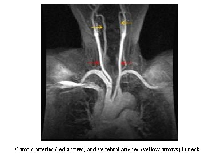 Carotid arteries (red arrows) and vertebral arteries (yellow arrows) in neck 