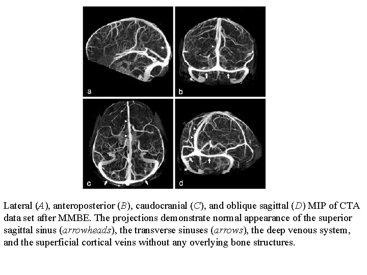 Lateral (A), anteroposterior (B), caudocranial (C), and oblique sagittal (D) MIP of CTA data