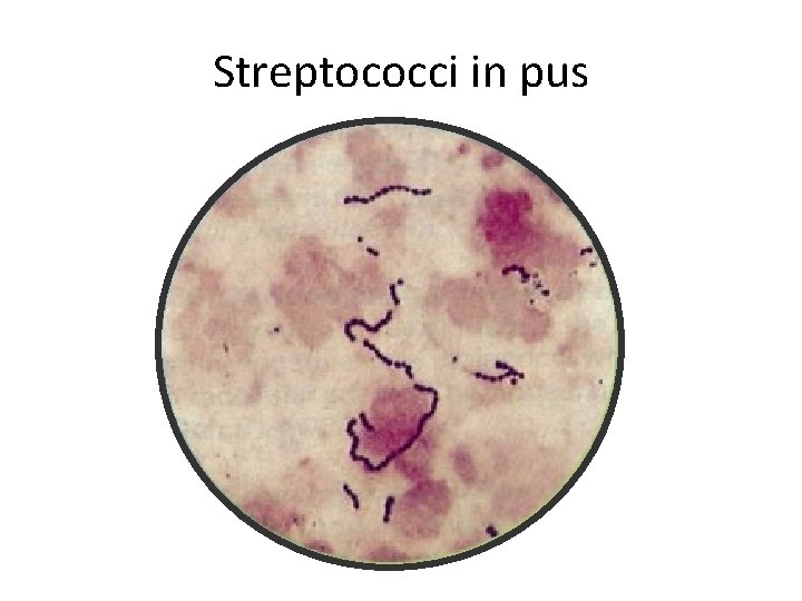 Streptococci in pus 