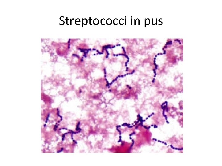 Streptococci in pus 