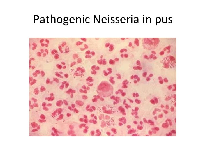 Pathogenic Neisseria in pus 
