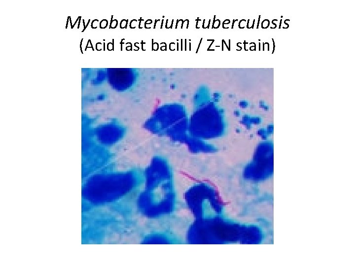 Mycobacterium tuberculosis (Acid fast bacilli / Z-N stain) 