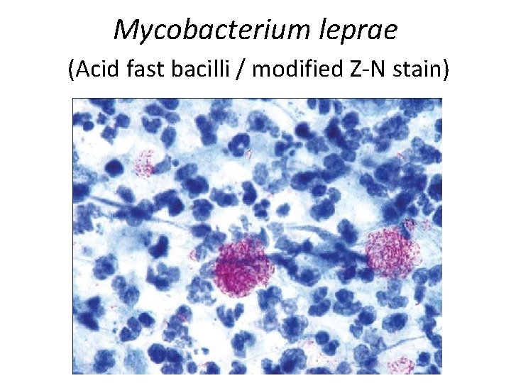 Mycobacterium leprae (Acid fast bacilli / modified Z-N stain) 