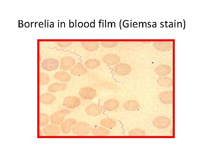 Borrelia in blood film (Giemsa stain) 