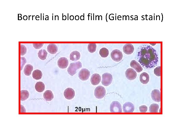 Borrelia in blood film (Giemsa stain) 