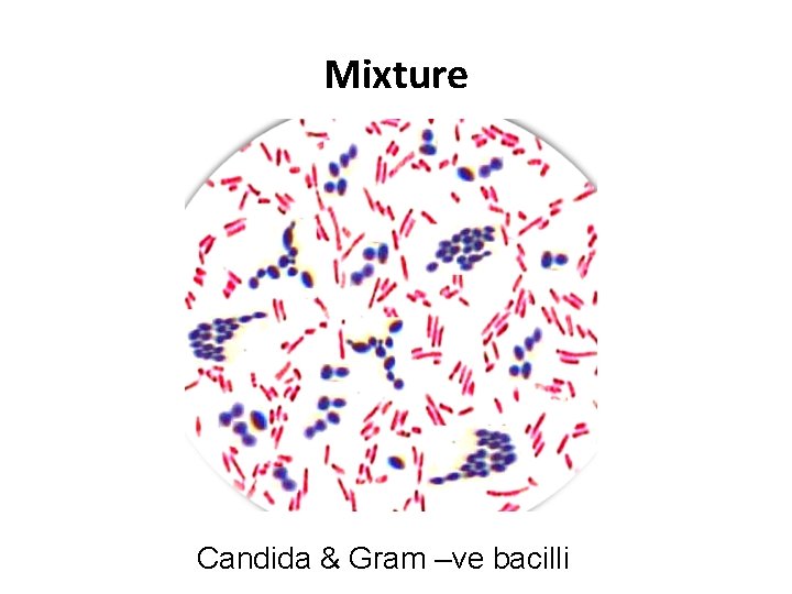 Mixture Candida & Gram –ve bacilli 