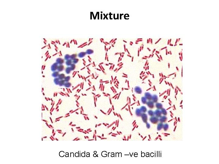 Mixture Candida & Gram –ve bacilli 