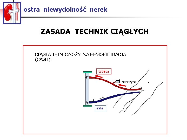 ostra niewydolność nerek ZASADA TECHNIK CIĄGŁYCH CIĄGŁA TĘTNICZO-ŻYLNA HEMOFILTRACJA (CAVH) CAVH tętnica heparyna żyła