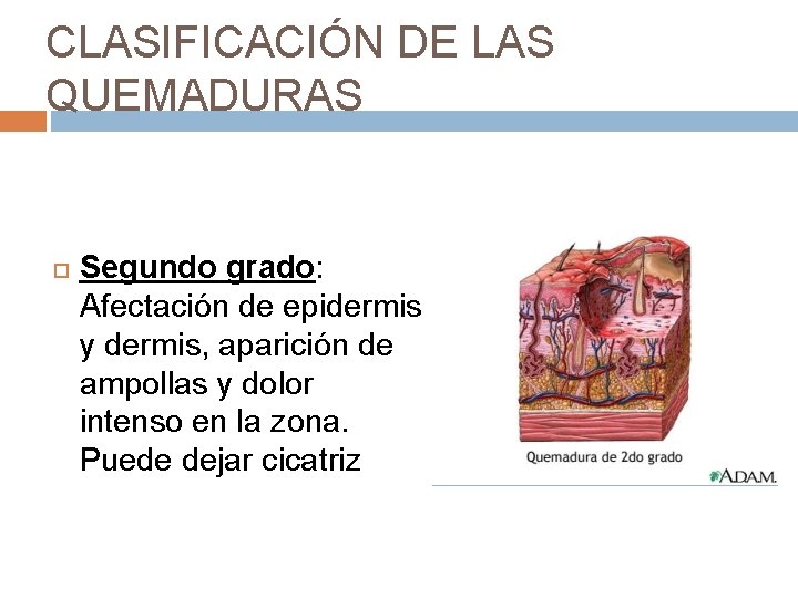 CLASIFICACIÓN DE LAS QUEMADURAS Segundo grado: Afectación de epidermis y dermis, aparición de ampollas