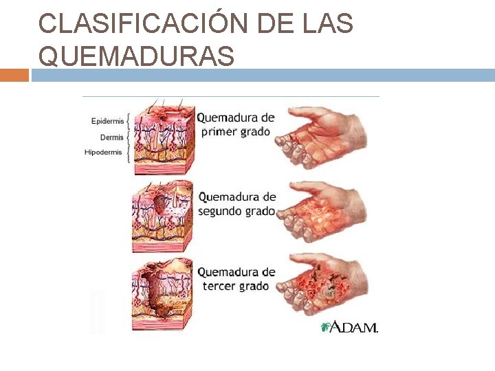 CLASIFICACIÓN DE LAS QUEMADURAS 