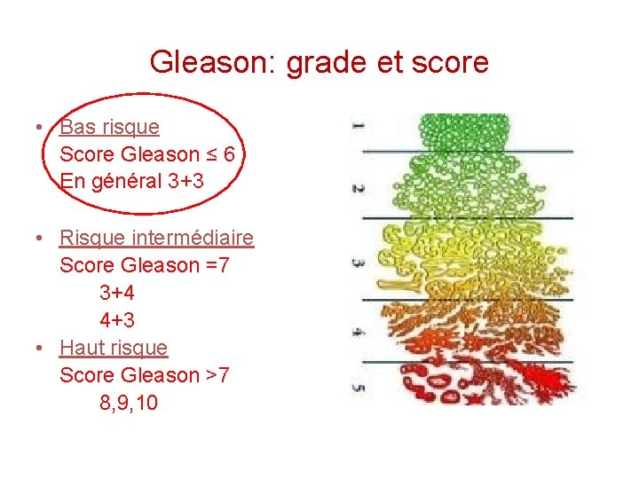Prostate cancer gleason score 7 43