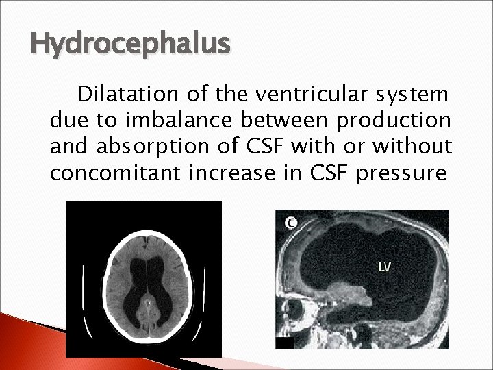 Hydrocephalus Dilatation of the ventricular system due to imbalance between production and absorption of