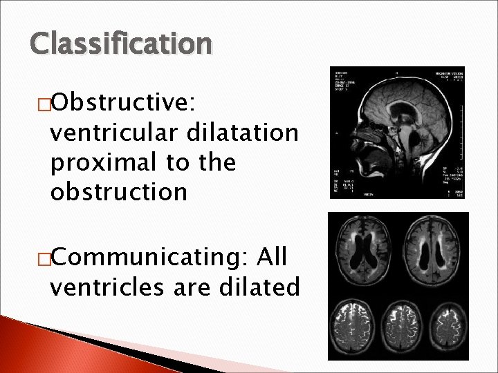 Classification �Obstructive: ventricular dilatation proximal to the obstruction �Communicating: All ventricles are dilated 