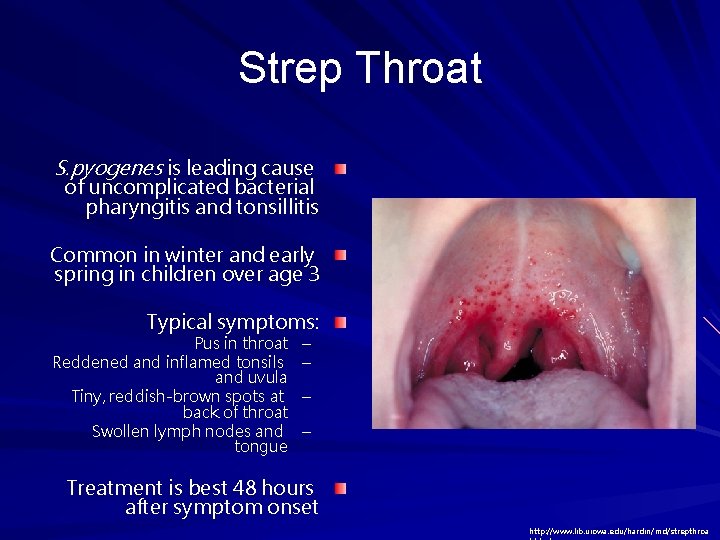 Strep Throat S. pyogenes is leading cause of uncomplicated bacterial pharyngitis and tonsillitis Common Strep Throat S. pyogenes is leading cause of uncomplicated bacterial pharyngitis and tonsillitis Common