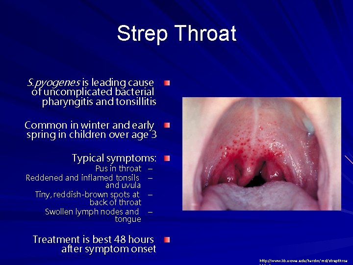 Strep Throat S. pyogenes is leading cause of uncomplicated bacterial pharyngitis and tonsillitis Common