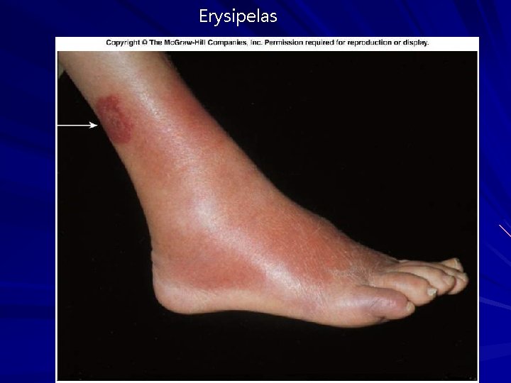 Erysipelas Erysipelas