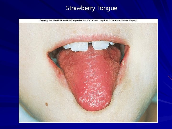 Strawberry Tongue Strawberry Tongue