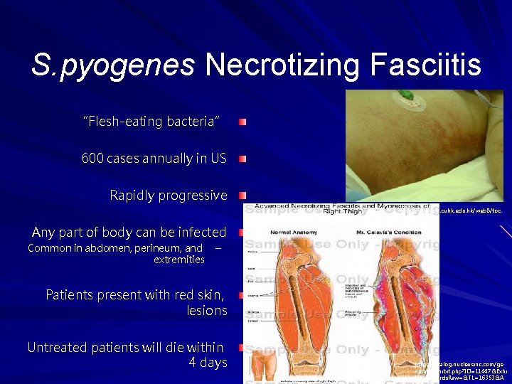 S. pyogenes Necrotizing Fasciitis “Flesh-eating bacteria” 600 cases annually in US Rapidly progressive http: