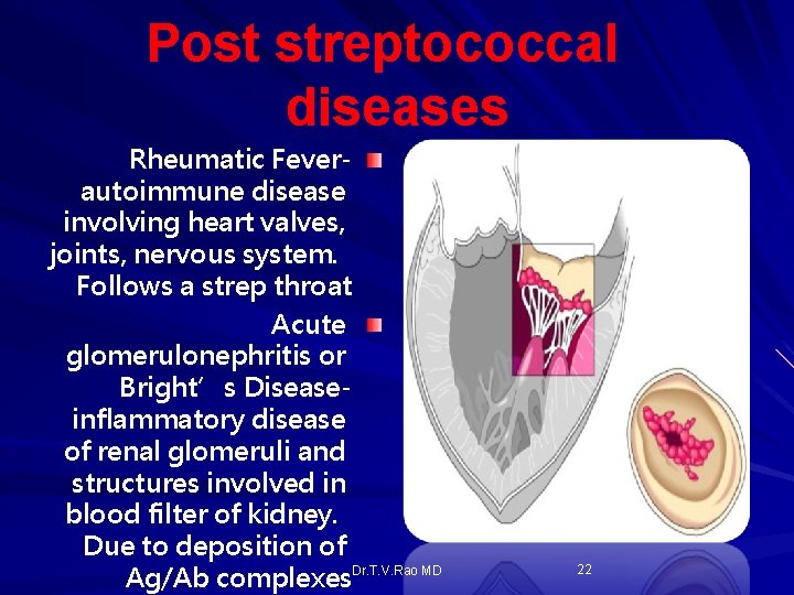 Post streptococcal diseases Rheumatic Feverautoimmune disease involving heart valves, joints, nervous system. Follows a