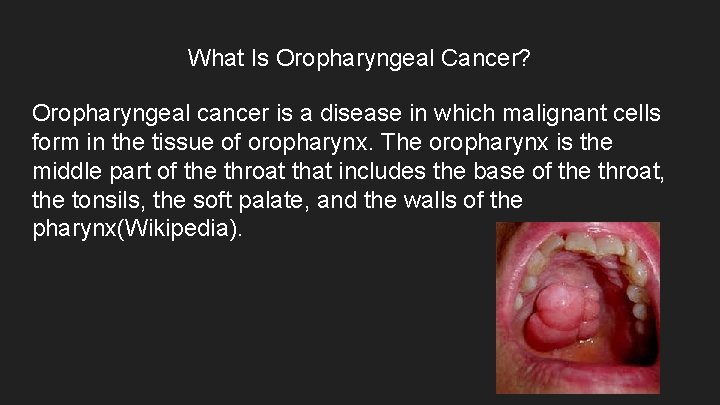 What Is Oropharyngeal Cancer? Oropharyngeal cancer is a disease in which malignant cells form