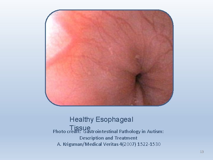 Healthy Esophageal Tissue Photo credit: Gastrointestinal Pathology in Autism: Description and Treatment A. Krigsman/Medical