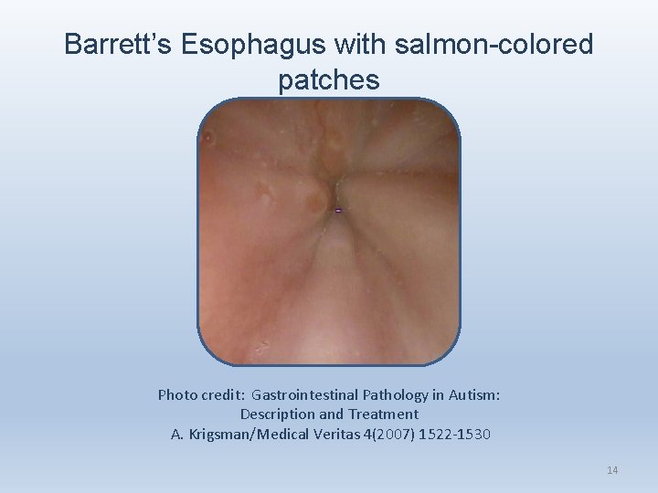 Barrett’s Esophagus with salmon-colored patches Photo credit: Gastrointestinal Pathology in Autism: Description and Treatment