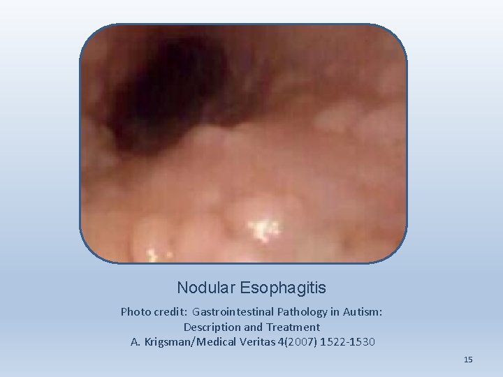 Nodular Esophagitis Photo credit: Gastrointestinal Pathology in Autism: Description and Treatment A. Krigsman/Medical Veritas