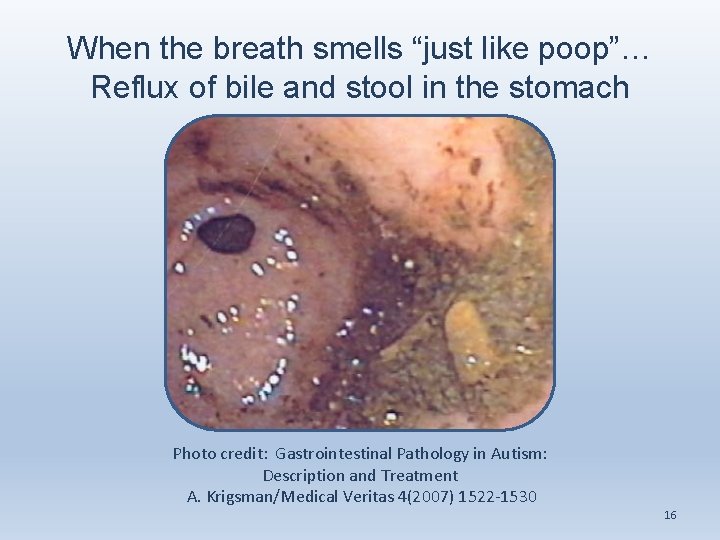 When the breath smells “just like poop”… Reflux of bile and stool in the
