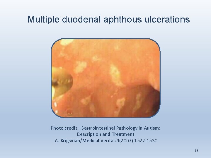 Multiple duodenal aphthous ulcerations Photo credit: Gastrointestinal Pathology in Autism: Description and Treatment A.