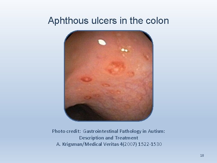 Aphthous ulcers in the colon Photo credit: Gastrointestinal Pathology in Autism: Description and Treatment
