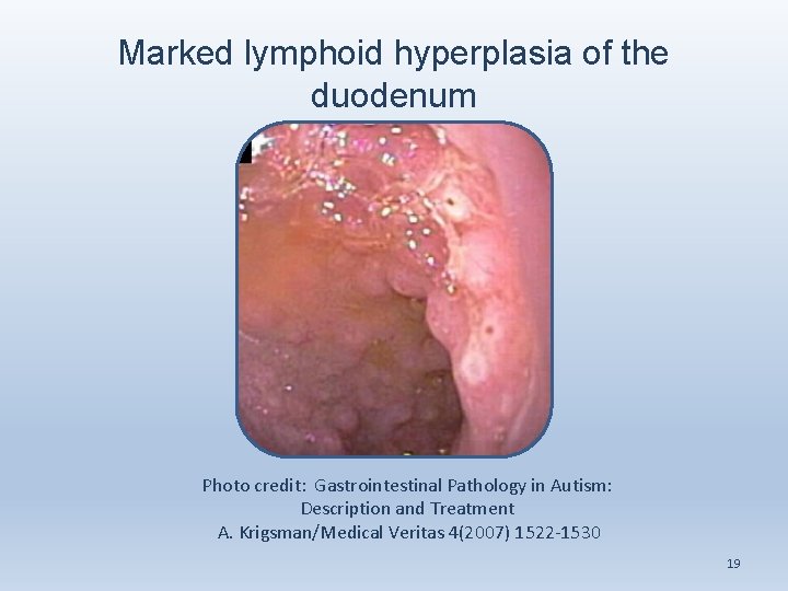 Marked lymphoid hyperplasia of the duodenum Photo credit: Gastrointestinal Pathology in Autism: Description and