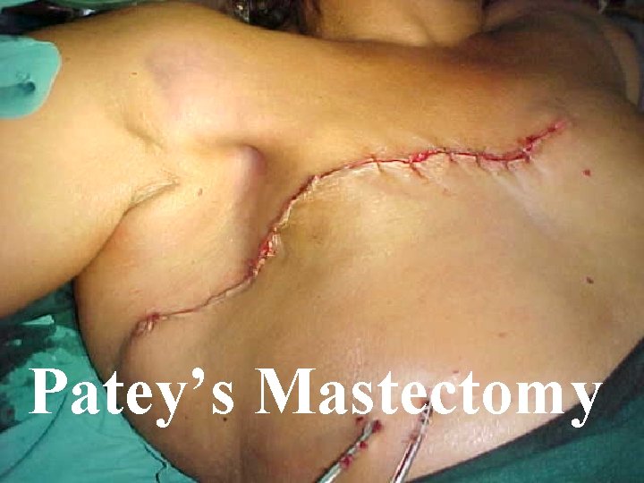 Patey’s Mastectomy Patey’s Mastectomy