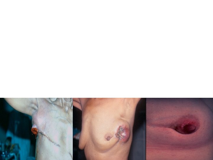 Who developed systemic recurrence ? Who developed systemic recurrence ?